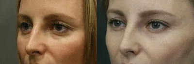 Липофилинг лица, Фото сделано через пол года после операции.