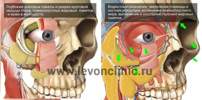 Липолитики от мешков под глазами