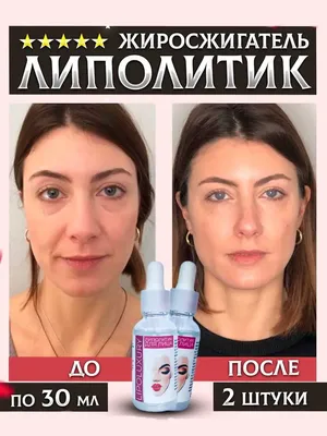 Процедуры инъекции липолитиков от 1990 руб/мл - BeautyWay Clinic 8 (499)  393-36-16