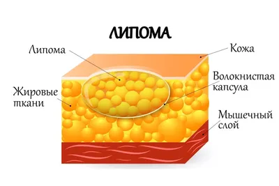 Липомы безвредны. Большая их часть