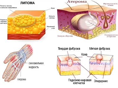 Липомы, атеромы, гигромы и фибромы кожи – что это такое? | Evolutis Clinic  | Дзен