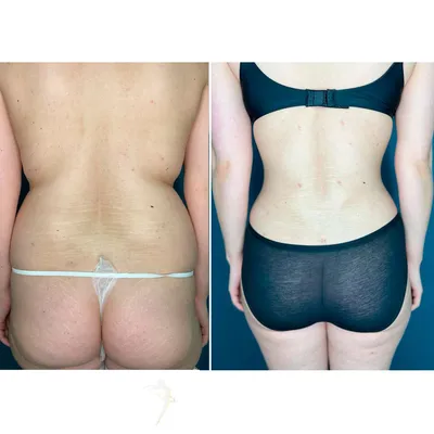 Липосакция живота и боков: до и после 🪄 Липосакция направлена НЕ на  похудение, а на устранение жировых ловушек. Однако, при сочетании… |  Instagram