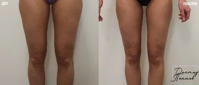 Липосакция ног фото до и после фото