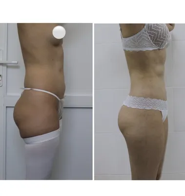Липосакция спины в Москве для женщин и мужчин, фото до и после, цены на  операцию