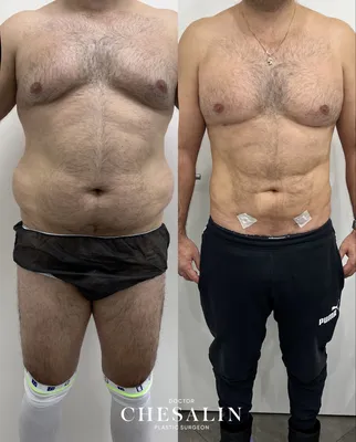 Липосакция у мужчин фото до и после фото