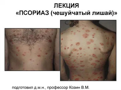 Псориаз (чешуйчатый лишай)... - Dermatoloq Rufat Nasibov | Facebook