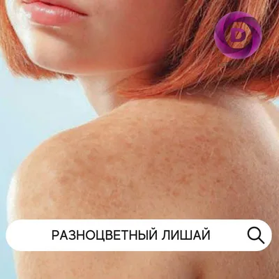 Что такое Белый лишай и как его лечить?