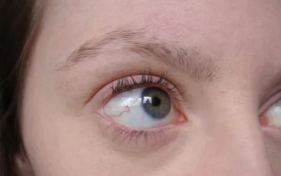 Опоясывающий лишай глаза может вызвать серьезное ухудшение зрения |  Здоровье Mail.ru | Дзен