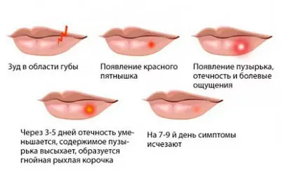 Псориаз: симптомы и лечение, причины возникновения псориаза, псориаз у  взрослых и детей