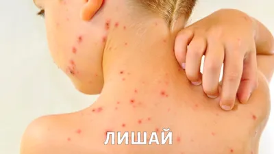 Псориаз экзема крем против продуктов | AliExpress