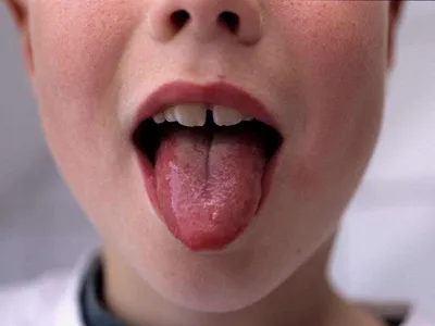 Белые пузырьки на языке у ребенка. Причины заболевания. Методы лечения |  Dental Art