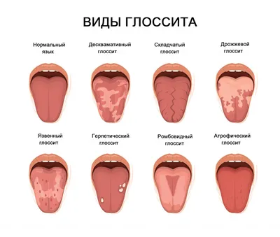 Красный плоский лишай - Дерматологическая патология - Справочник MSD  Профессиональная версия