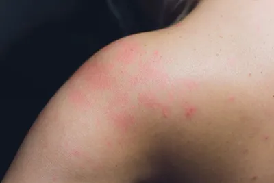 Себорейный дерматит на лице беспокоил моего пациента около 10 лет! ⠀  Листайте галерею 👉🏻 и посмотрите, как может проявлять себя данный… |  Instagram