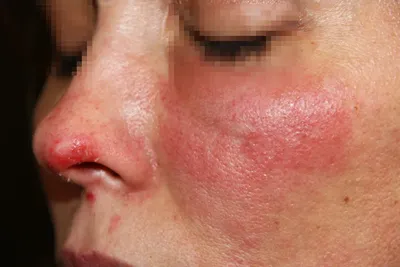 Опоясывающий лишай на лице: фото, симптомы и лечение. Откуда опоясывающий  лишай на лице