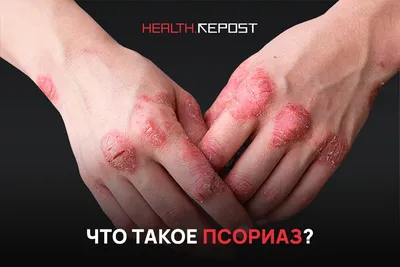 Что такое Белый лишай и как его лечить?