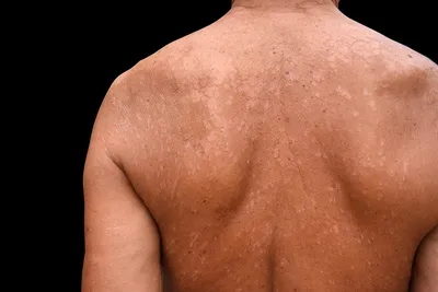 Сыпь на коже: что делать? | НаПоправку - врачи онлайн 24/7 | Дзен