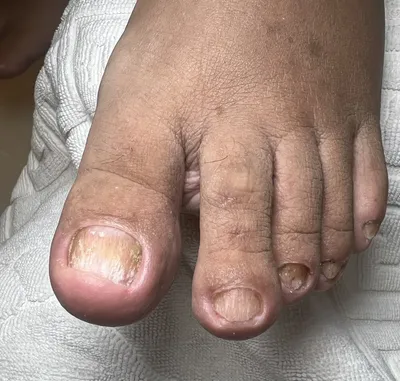 Псориаз в ноге стоковое изображение. изображение насчитывающей дерматология  - 91802277