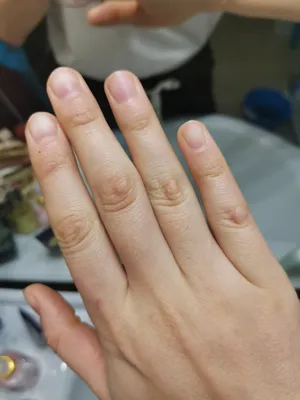 Грибная инфекция на ногтях руке, пальце с Onychomycosis - мягкий фокус  Стоковое Фото - изображение насчитывающей плоть, ногти: 73312962