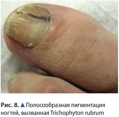Палец с Onychomycosis Грибок Toenail - мягкий фокус Стоковое Изображение -  изображение насчитывающей деформировано, накожно: 73523703