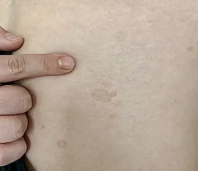 Сыпь на руке человека стоковое фото. изображение насчитывающей медицинско -  145977518