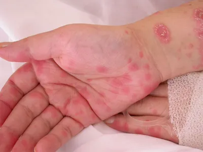Красная аллергия, сыпь, дерматит на руке ребенка, крупный план, Стоковые  видеоматериалы Включая: рука и сыпь - Envato Elements