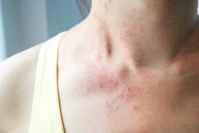 Dermatologs.lv - #Псориаз, или чешуйчатый лишай, – часто... | Facebook