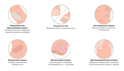 Опоясывающий лишай. Наиболее распростарненные признаки