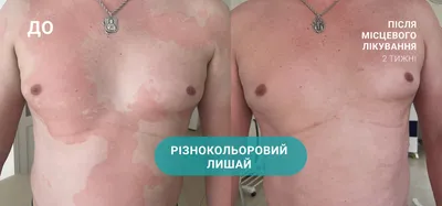 Лечение розового лишая Жибера в Одессе и Киеве - дерматология VIRTUS