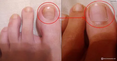 ПСОРИАЗ НОГТЕЙ 👉На фото подозрение на псориаз ногтей. Возможно вторично  присоединён грибок. 👣Мы взяли результат на анализ , будем ждать р… |  Instagram
