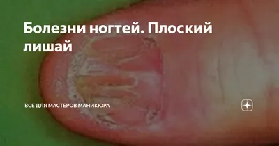 Псориаз ногтей — Derma.ua