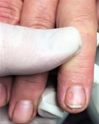Как лечить псориаз ногтей - Vitimed