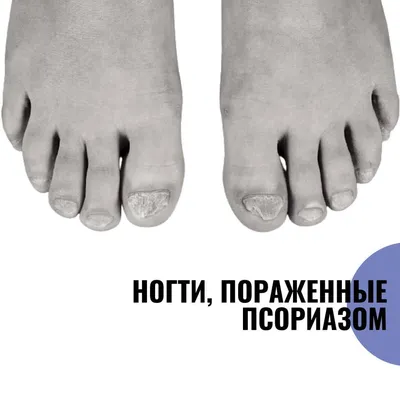 Псориаз и дистрофия ногтевой пластины | Московская Клиника Подологии
