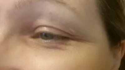 Красные глаза: причины, лечение, болезни. Что делать, если лопнул сосуд?