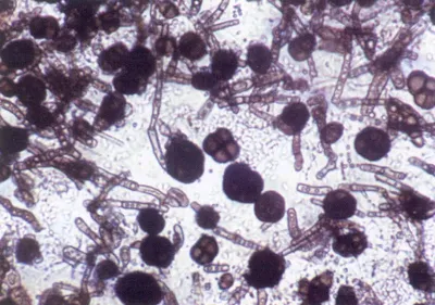 Грибок Dermatophyte под микроскопом Стоковое Фото - изображение  насчитывающей микроскоп, колония: 177859286