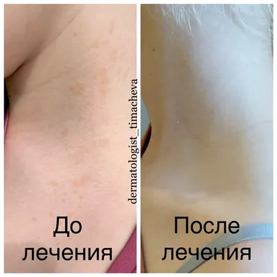 Опоясывающий лишай (опоясывающий герпес, herpes zoster): симптомы и  профилактика