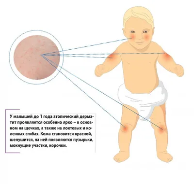 Кожный атопический дерматит у младенцев, детей, подростков: проявления, как  лечить?