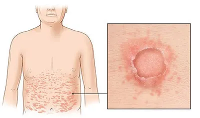 Опоясывающий лишай (опоясывающий герпес, herpes zoster): симптомы и  профилактика