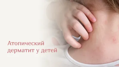 Семейная Клиника Family Health Clinic - Атопический дерматит занимает  первое место среди аллергических заболеваний у малышей и подростков.  Главная причина возникновения атопического дерматита – генетическая  предрасположенность. В семьях, где оба ...