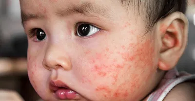 Пеленочный дерматит или опрелость кожи у малыша: что делать? Советы  дерматолога