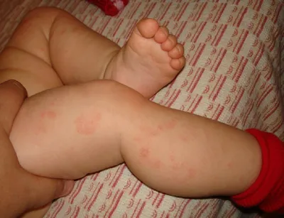 Себорейный дерматит у ребенка на голове: лечение, отзывы, фото, причины  возникновения, профилактика в домашних условиях