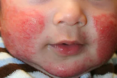 Пеленочный дерматит дифференциальная диагностика, лечение, симптомы, фото -  Университет здорового ребёнка Няньковских