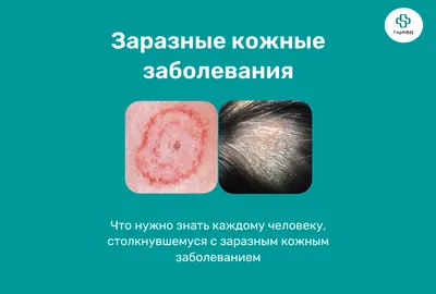 Лечение стригущего лишая (микроспория) в Киеве — Derma.ua