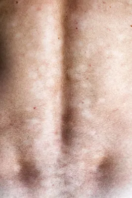 Красные пятна на теле | причины появления пятен на коже, лечение,  диагностика и профилактика