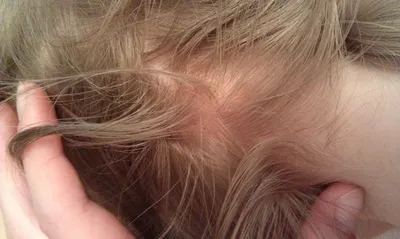 Фунгицидный препарат БиоХимФарм Акамиксан - «Лечение стригущего лишая  (микроспория) у ребенка на волосистой части головы. Супер состав: и цинк, и  сера, и скипидар, и деготь. Должен был помочь, тогда же почему лишай