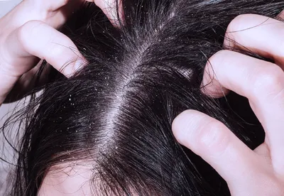 Что нужно знать об инфекциях кожи головы?