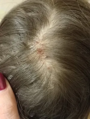 Псориаз волосистой части головы: причины, как выглядит, что делать, лечение