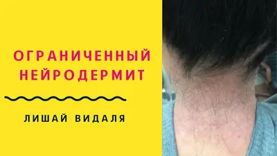 Асбестовидный лишай — Википедия