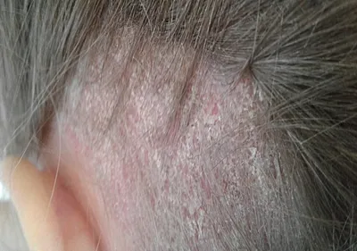 Псориаз волосистой части головы — симптомы, причины и методы лечения болезни