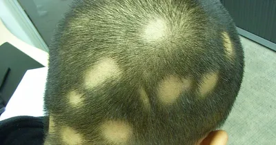 ᐉ Псориаз кожи головы - что это? Причины появления и методы лечения  псориаза на коже головы