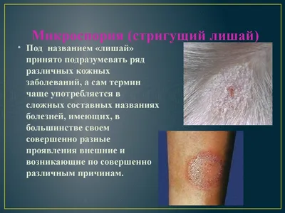 Лечение красного плоского лишая (Вильсона) в Киеве — Derma.ua